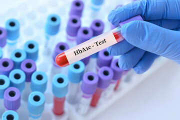 Doctor holding a test blood sample tube with HbA1c test on the background of medical test tubes...