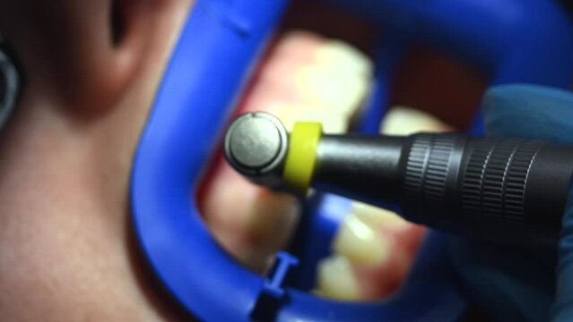 Dental Whitening process in patient mouth. Teeth whitening with UF Lamp, Led Lamp and gel. Dental Extreme Close up Macro Video. Concept of professional dental hygiene. 4k 120 fps slow motion footage