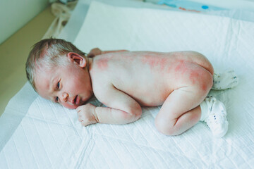 A newborn baby is lying on a diaper with a red rash on his body. Sweating of a newborn child. - obrazy, fototapety, plakaty
