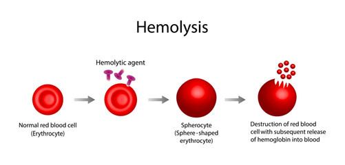 Hemolysis. Normal red blood cell, spherocyte, then destruction of red blood cell with subsequent release of hemoglobin into blood. Vector illustration