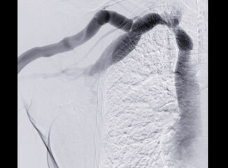 Balloon Angioplasty is a medical procedure used to widen narrowed or blocked blood vessels.