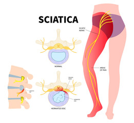 The Sciatica nerve pain of lower back through hips to leg and degenerative disc disease