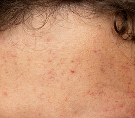 allergic red rash on the face. - obrazy, fototapety, plakaty