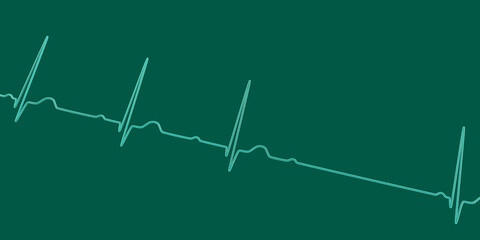 An ECG with 2nd degree AV block, 3D illustration