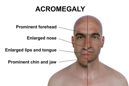 Acromegaly in a man, and the same healthy man, 3D illustration