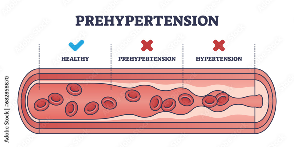 Poster Prehypertension, healthy and hypertension blood flow comparison outline diagram. Labeled educational scheme with medical vessels and artery conditions for high blood pressure vector illustration.