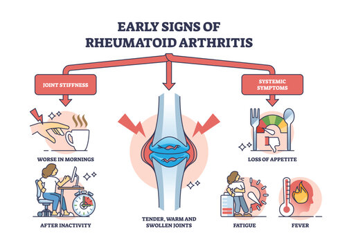 Early signs of rheumatoid arthritis disease and joint pain outline diagram. Labeled educational stiffness and systemic symptom explanation vector illustration. Cartilage tender, warm and swollen.