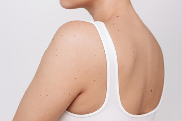 Cropped shot of a young woman with a large number of moles isolated on a white background. The effect of sunlight on the skin. Birthmarks on the female body - obrazy, fototapety, plakaty