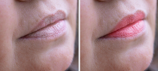 close up part face, lips mature woman 55 years old, chapped lips before and after procedure, skin...