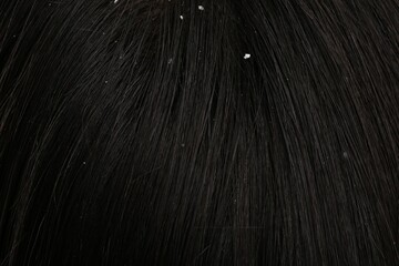 Woman with dandruff in her dark hair, closeup view