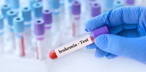 Doctor holding a test blood sample tube with leukemia test on the background of medical test tubes...