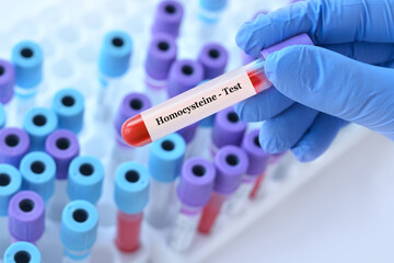 Doctor holding a test blood sample tube with homocysteine test on the background of medical test...