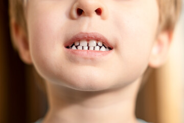 Close up headshot cropped image of little preschool cute boy widely smiling, showing the first baby...