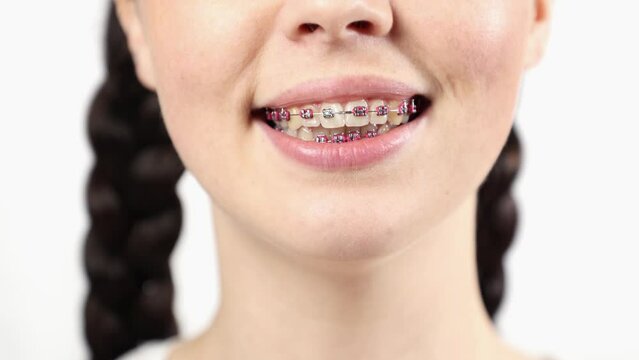 Close-up of woman holding magnifying glass and showing zoomed teeth with ligature braces. Concept of orthodontic treatment