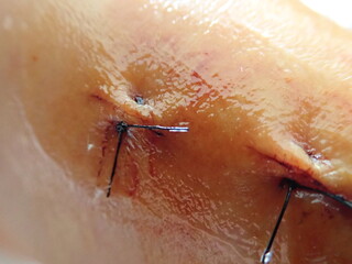 stitches on a scar on a knee - obrazy, fototapety, plakaty