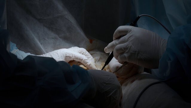 Cardiac surgeon and team perform median sternotomy. Action. Surgeon cauterizing and using professional tool.