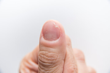 close up, fingernail, dead root nail, onychogaphy, dermatology, fingernail