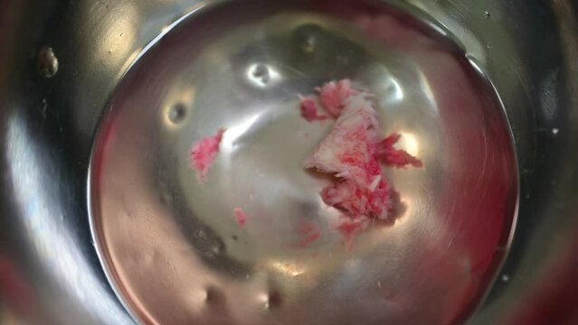  Herniated lumbar discs in a surgical bowl of water after herniated disc surgery.