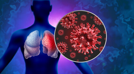 Pneumonia Outbreak Virus pathogen Lung Infection and Human lung infections or respiratory inflammation disease as influenza flu outbreak or pulmonary inflammatory illness. - obrazy, fototapety, plakaty