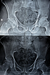 Plain X-ray of both hip joints revealed slight narrowing of superolateral aspect of both hip joints...