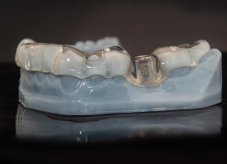 Innovation in Dentistry: Detail of 3D Printed Dental Model