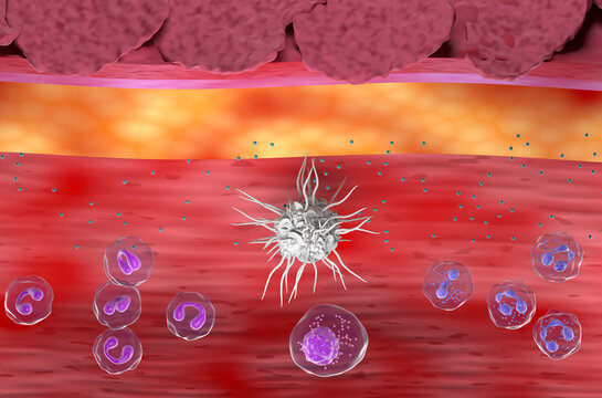Inflammatory skin in Eczema, Atopic Dermatitis (AD) - top view 3d illustration