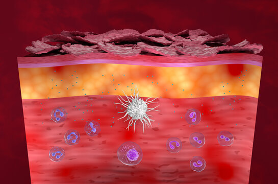 Inflammatory skin in Eczema, Atopic Dermatitis (AD) - isometric view 3d illustration