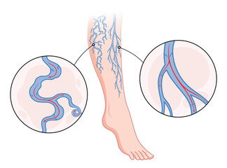 Varicose veins. Blue blood vessel visible through the skin, abnormally swollen leg. Vascular disease diagnostic and treatment. Venous insufficiency medical disease - obrazy, fototapety, plakaty