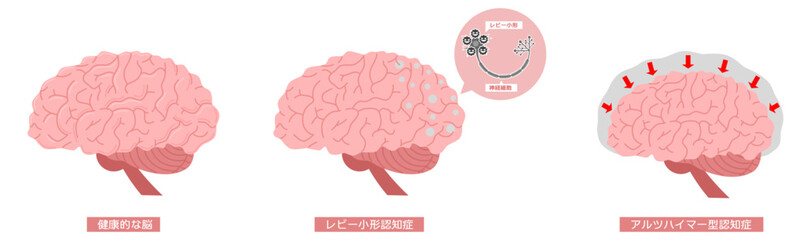 脳の病気　認知症※Affinity Designer作成svgファイル	