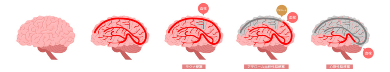 脳梗塞セット※Affinity Designer作成svgファイル	