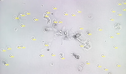 Photomicrographic close view of Abnormal urine analysis showing plenty pus cell