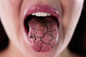 Cracks in the Oral Cavity Inducing Dry Mouth