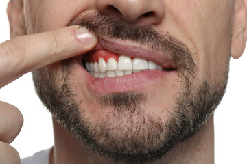 Man showing inflamed gum on white background, closeup