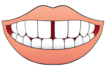 Tooth Gap