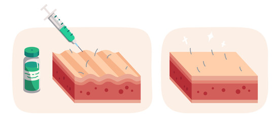 Cosmetic injection skin treatment. Syringe inject collagen in skin layer, before and after wrinkle therapy. Face beauty cosmetology, mesotherapy rejuvenation medicine concept flat vector illustration