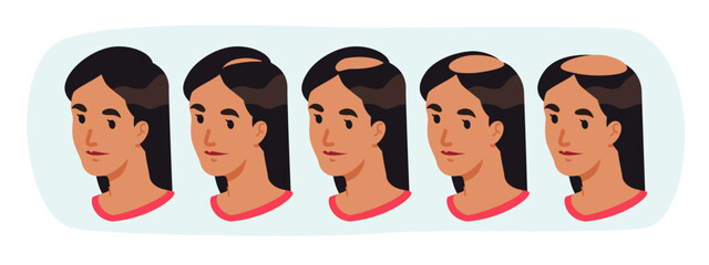 Woman hair loss head stages. Female person hairless bald scalp spot. Balding health problem steps. Human baldness, alopecia pattern, Hamilton-Norwood scale, healthcare flat vector illustration set