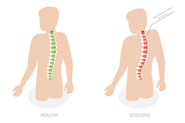 3D Isometric Flat  Conceptual Illustration of Scoliosis, Normal Spine and One with Defects - obrazy, fototapety, plakaty