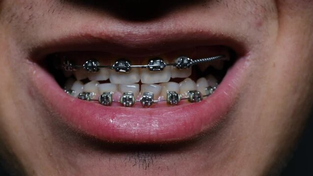 macro shot of man with braces, slow motion in 4k resolution