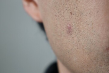 肌荒れした日本人男性の肌