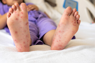 Enterovirus foot red spots blisters on the skin of on the body of a purple uniform child virus on bed at hospital - obrazy, fototapety, plakaty