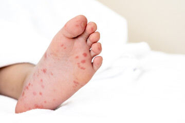 Enterovirus foot red spots blisters on the skin of on the body of a child virus on bed at hospital