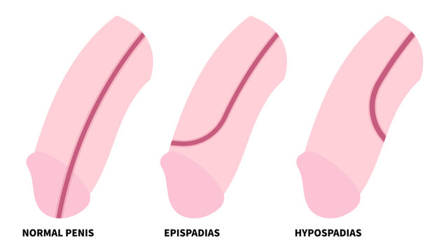 Genetic disorder with reproductive system that show abnormality of the urethra opening called Hypospadias