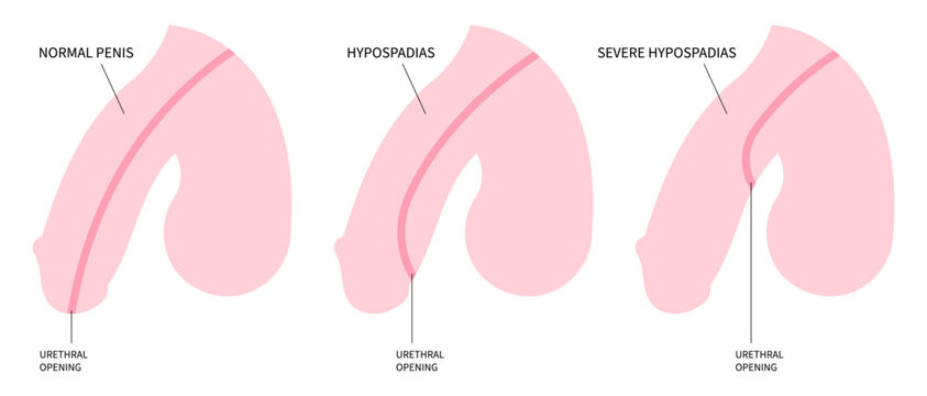 Medical anatomy that show abnormality of the urethra opening called Hypospadias