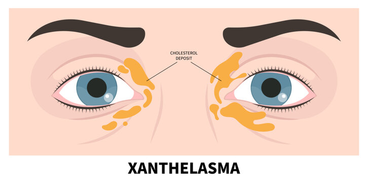 Eyelid skin with fatty deposits that the name in medical called Xanthelasma disease
