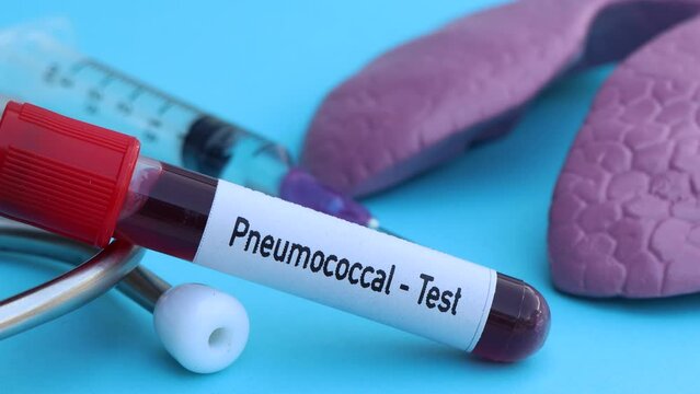 Pneumococcal test to look for abnormalities from blood, scientific experiment