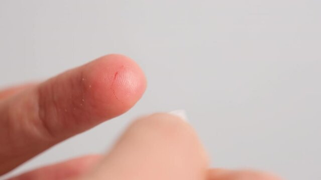 A close up view of a person finger removing a drop of blood with an alcohol wipe. Stoppage of blood after a test or a small cut or wound