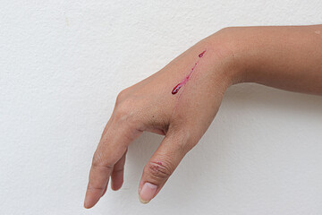 Fresh wound on the hand had blood on the skin. woman's red mark was bleeding. first aid