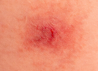 Close-up of a wound on the skin. Macro