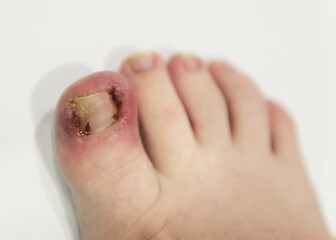 Child foot: onychocryptosis - an ingrown toenail