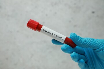 Laboratory worker holding tube with blood sample and label Liver Function Test against light...